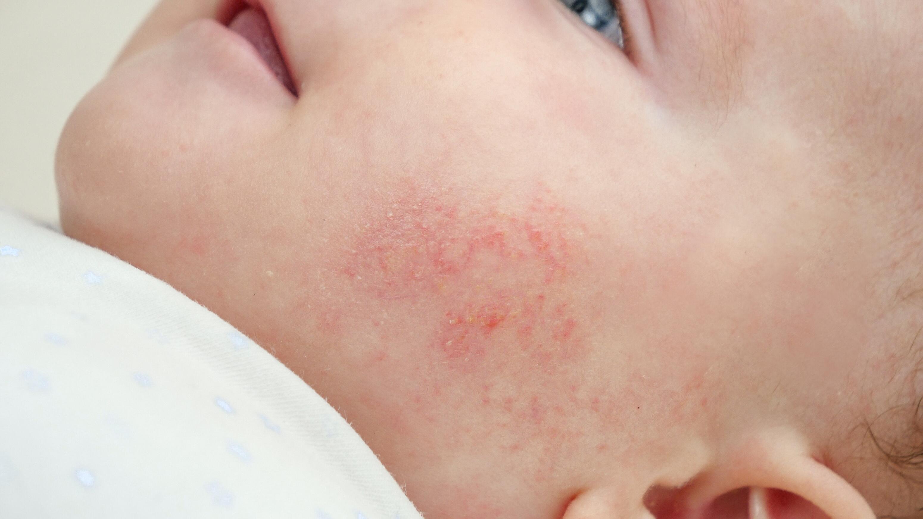 plaques d’eczéma bébé